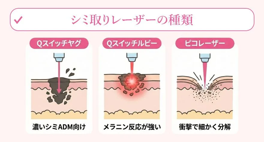シミ取りレーザーの種類と効果
